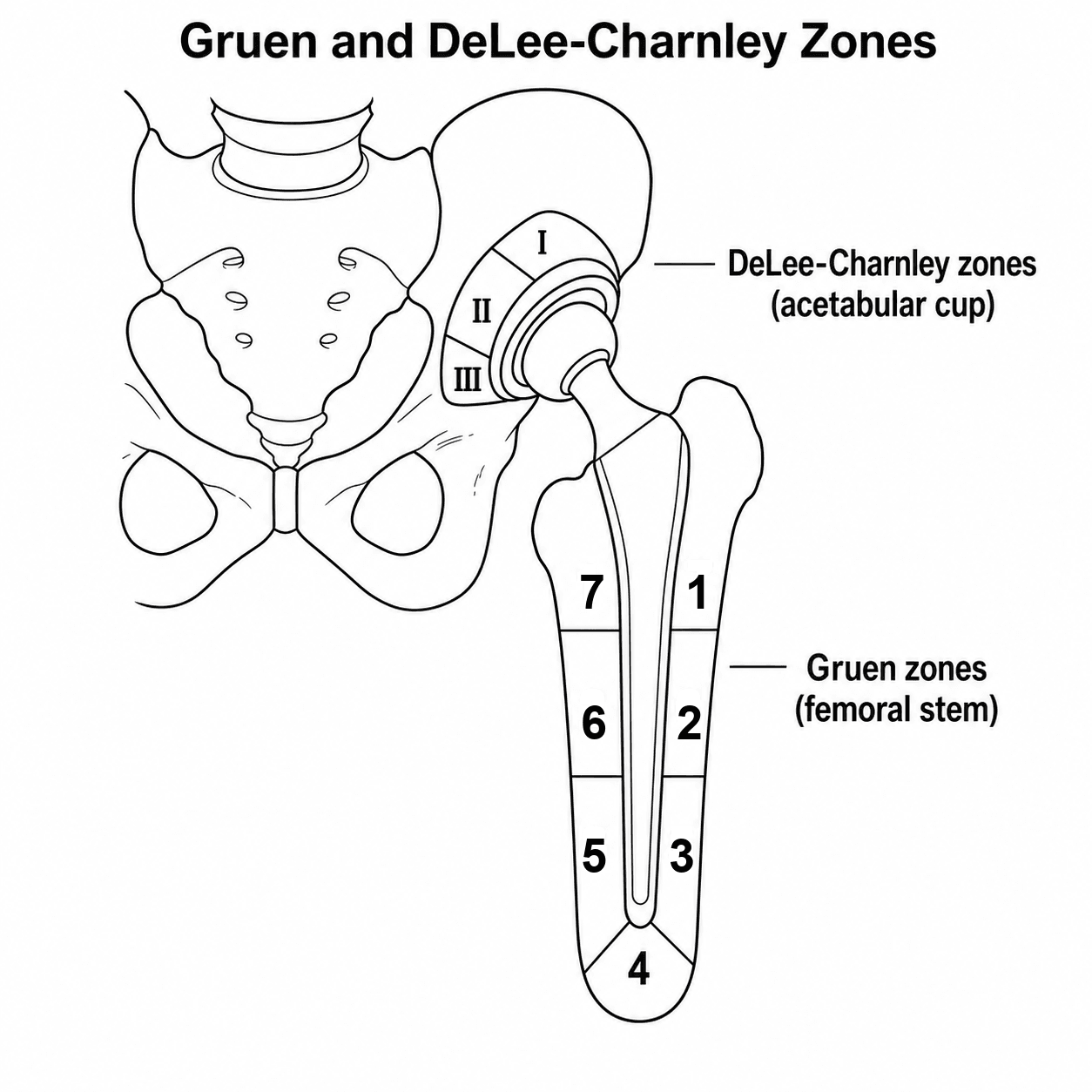Diagram of a total hip replacement showing the seven Gruen zones around the femoral stem and the three DeLee-Charnley zones around the acetabular cup.