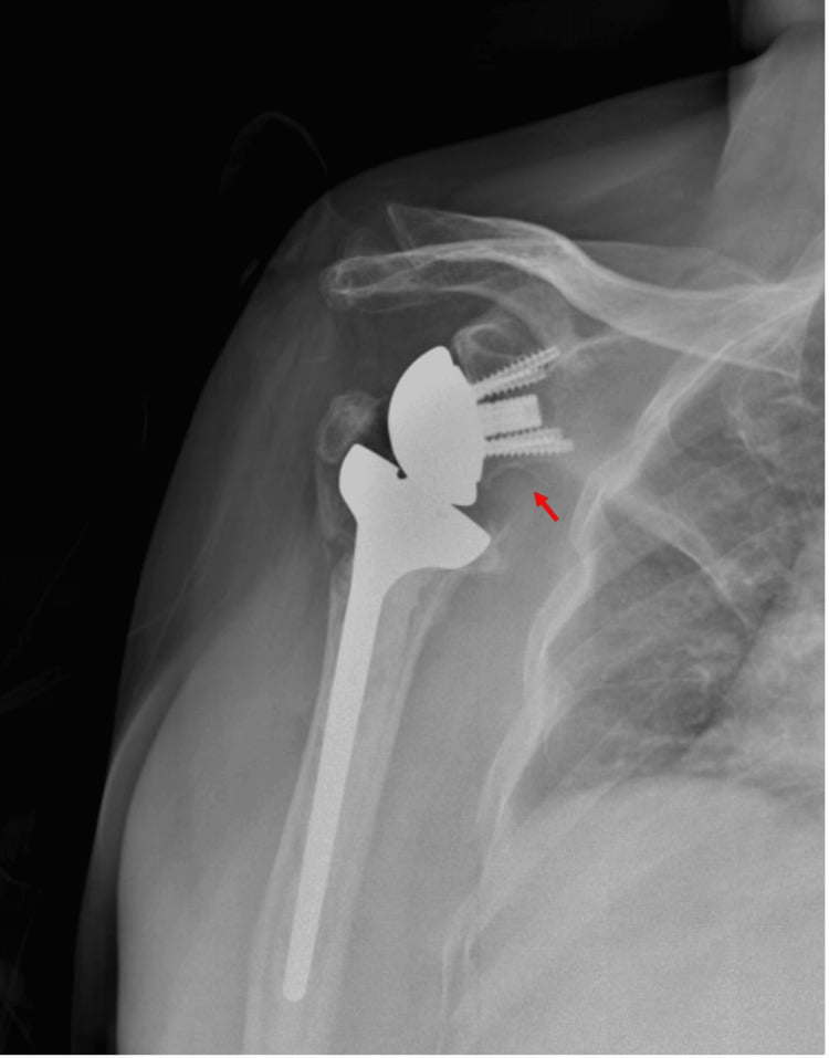 AP reverse shoulder arthroplasty radiograph showing grade I inferior scapular notching