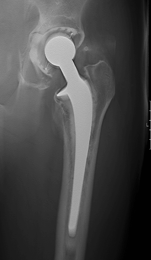 AP radiograph of a cemented total hip arthroplasty showing the femoral stem within its cement mantle