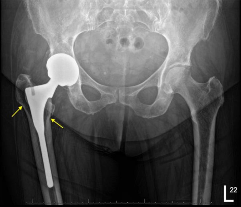 AP total hip arthroplasty radiograph showing radiolucent lines in proximal Gruen zones 1 and 7