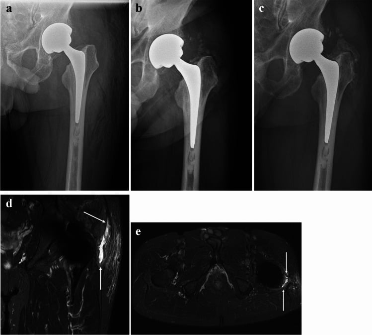 Serial hip radiographs and MRI showing progression of heterotopic ossification after total hip arthroplasty