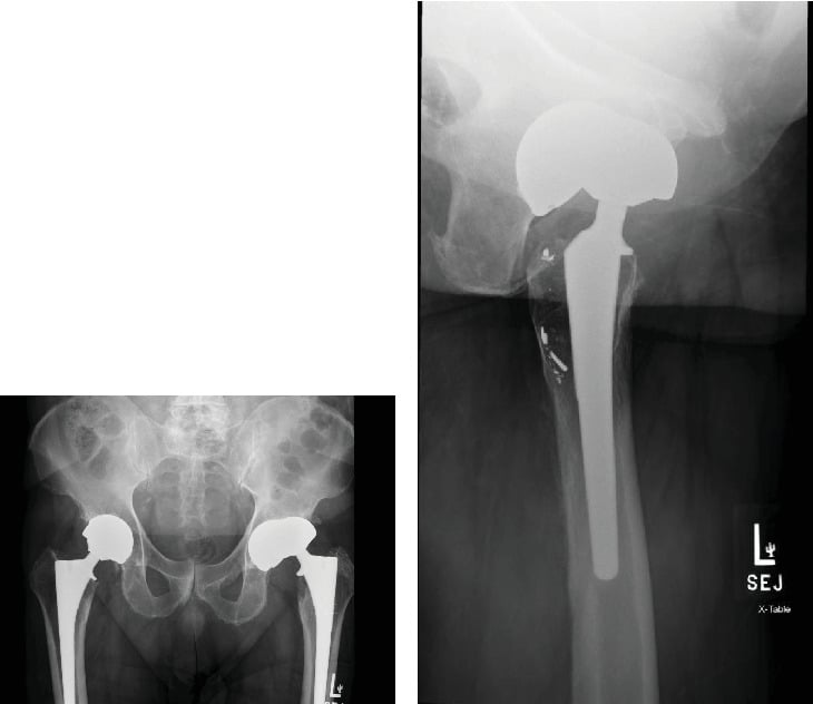 AP and lateral hip radiographs showing subluxation of a total hip arthroplasty with acetabular wear and osteolysis