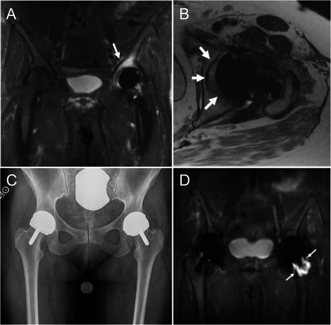 Multispectral metal artefact reduction MRI examples of soft-tissue complications around total hip arthroplasty