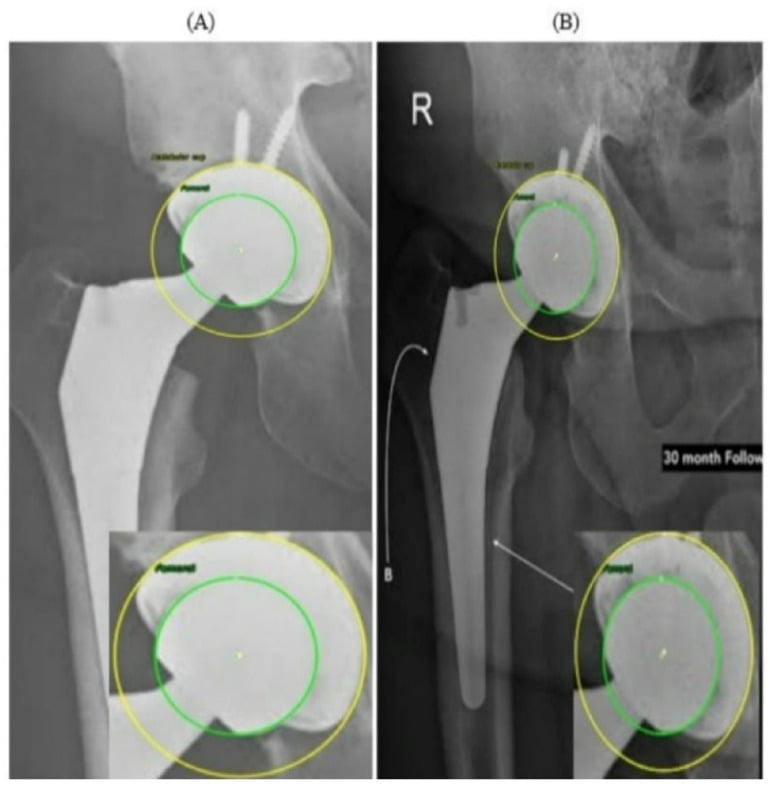 Serial AP hip radiographs with fitted circles demonstrating superior femoral-head displacement from polyethylene wear
