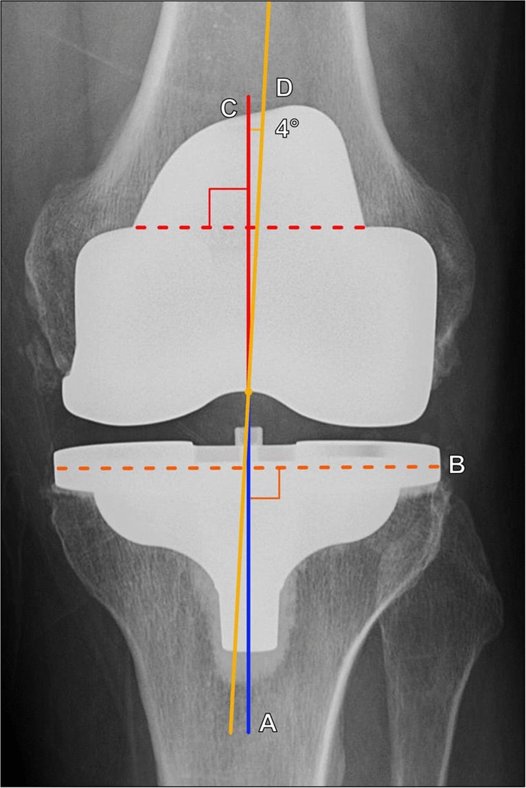 Annotated AP total knee arthroplasty radiograph showing tibial and femoral component alignment axes