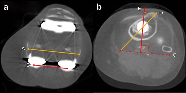 Axial metal artefact reduction CT images showing rotational assessment of total knee arthroplasty components