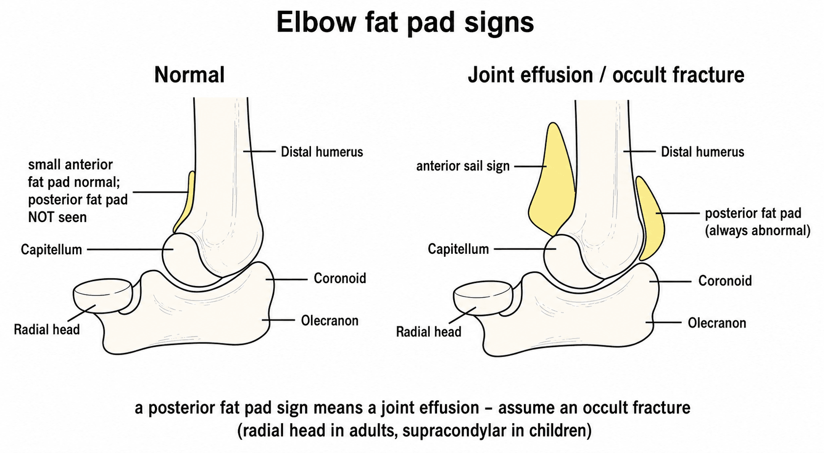 Schematic of elbow fat pad signs comparing a normal elbow with a joint effusion showing the anterior sail sign and a posterior fat pad