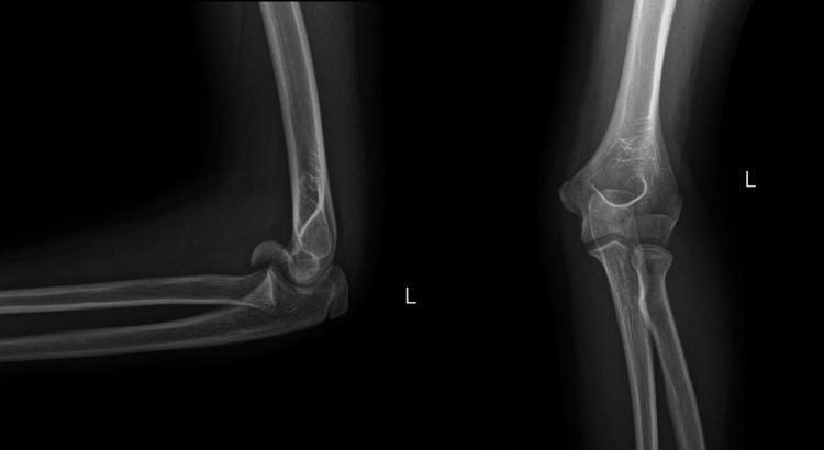 AP and lateral radiographs of a capitellar fracture with the double-arc sign