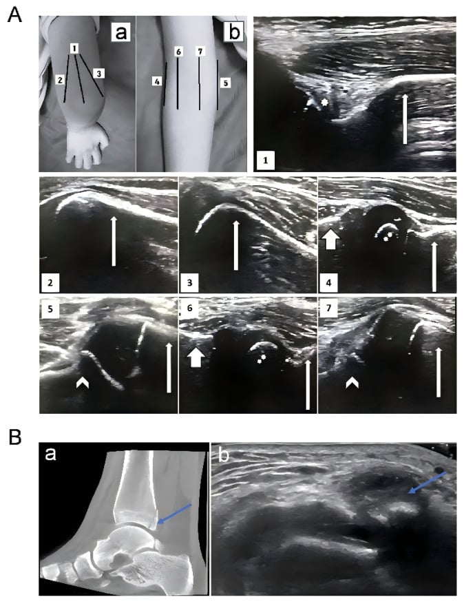 Ultrasound windows around the elbow in flexion and extension