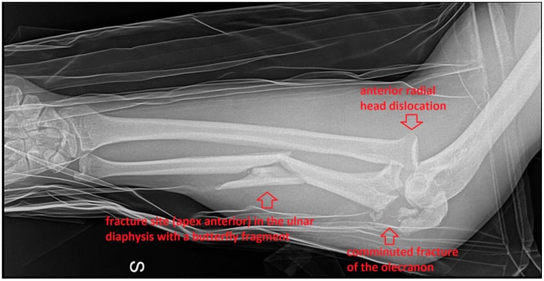 Initial forearm radiograph showing a Monteggia lesion with radial-head dislocation
