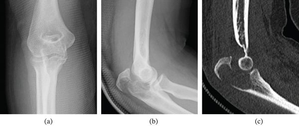 Elbow radiographs and sagittal CT showing an osteolytic olecranon lesion with pathological fracture