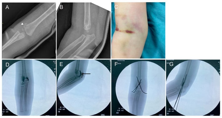 Paediatric AP and lateral elbow radiographs showing a transphyseal distal humerus fracture