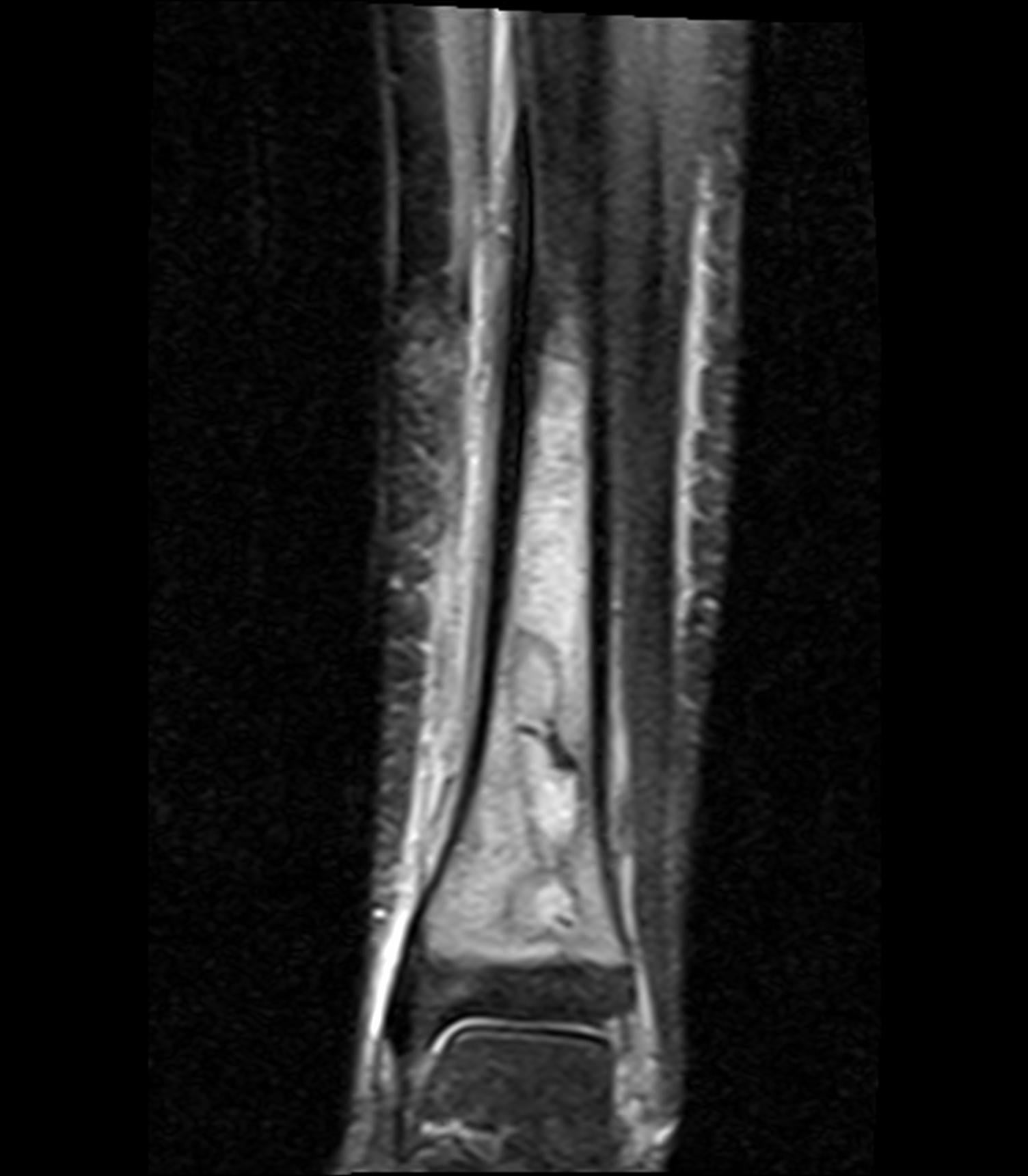 Coronal STIR MRI of the distal tibia showing marrow oedema around a Brodie abscess