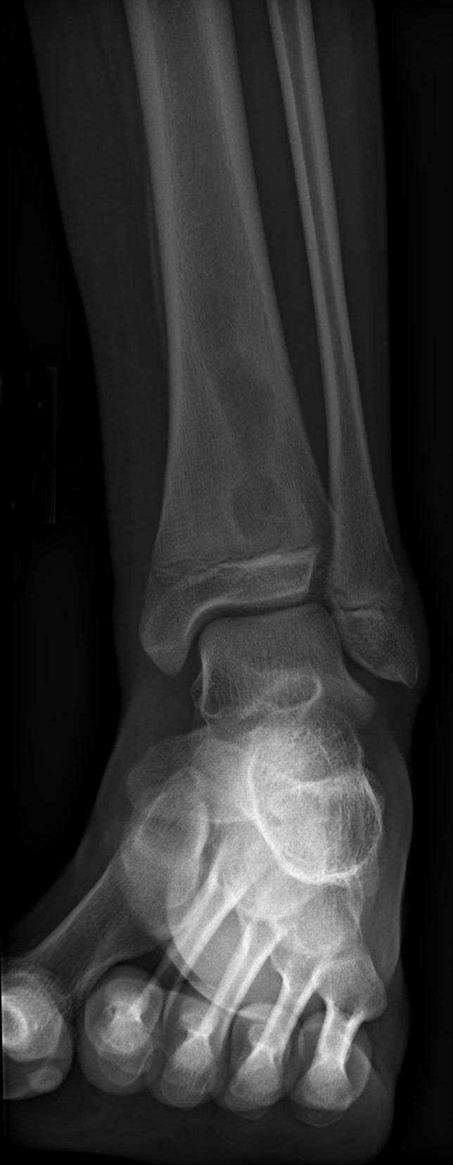 AP radiograph of the distal tibia showing a lytic Brodie abscess in the metaphysis