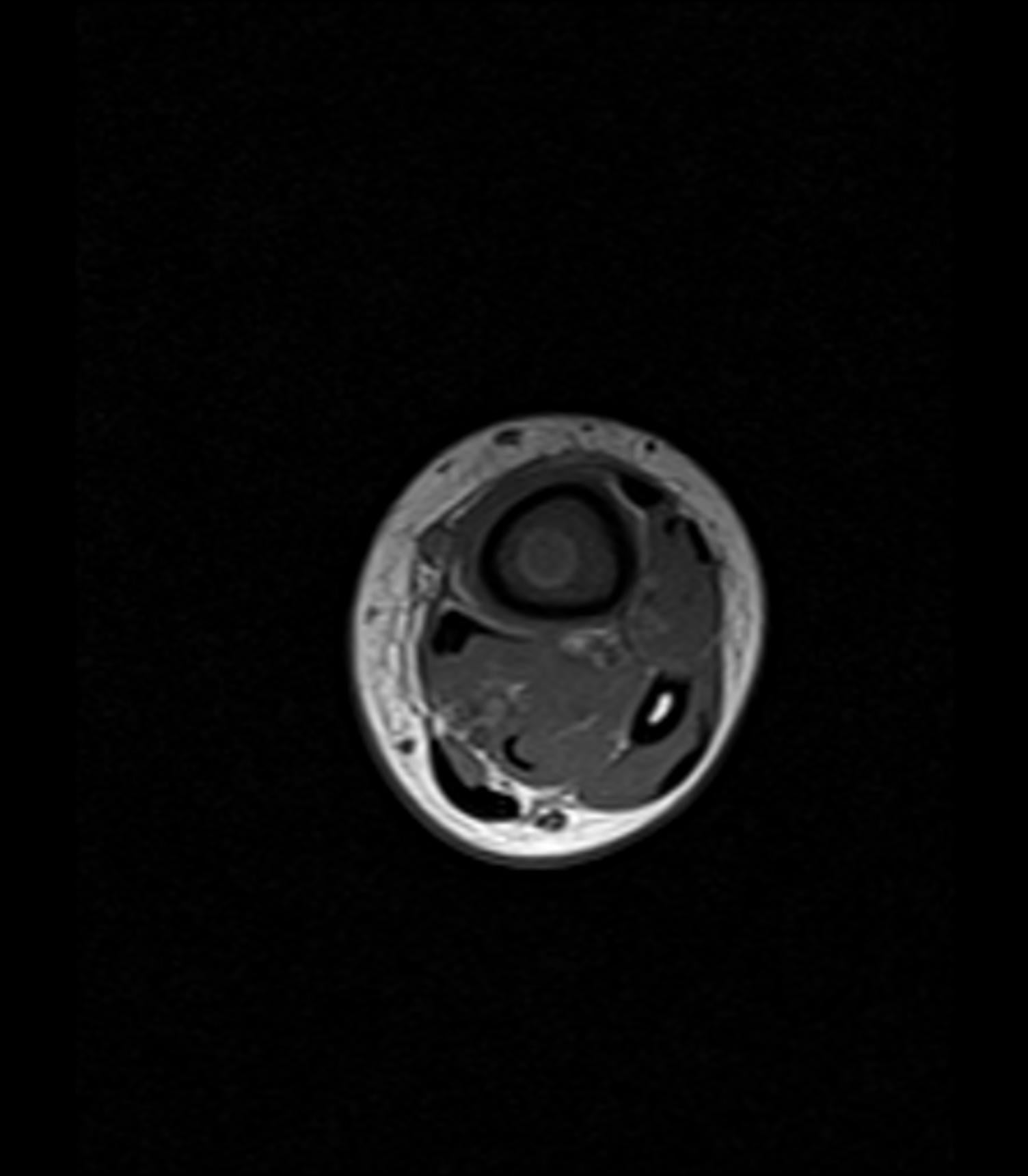 Axial T1 MRI of the distal tibia showing the penumbra sign of a Brodie abscess