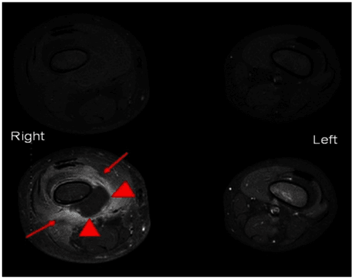 MRI of paediatric osteomyelitis showing distal femur marrow oedema and abscess