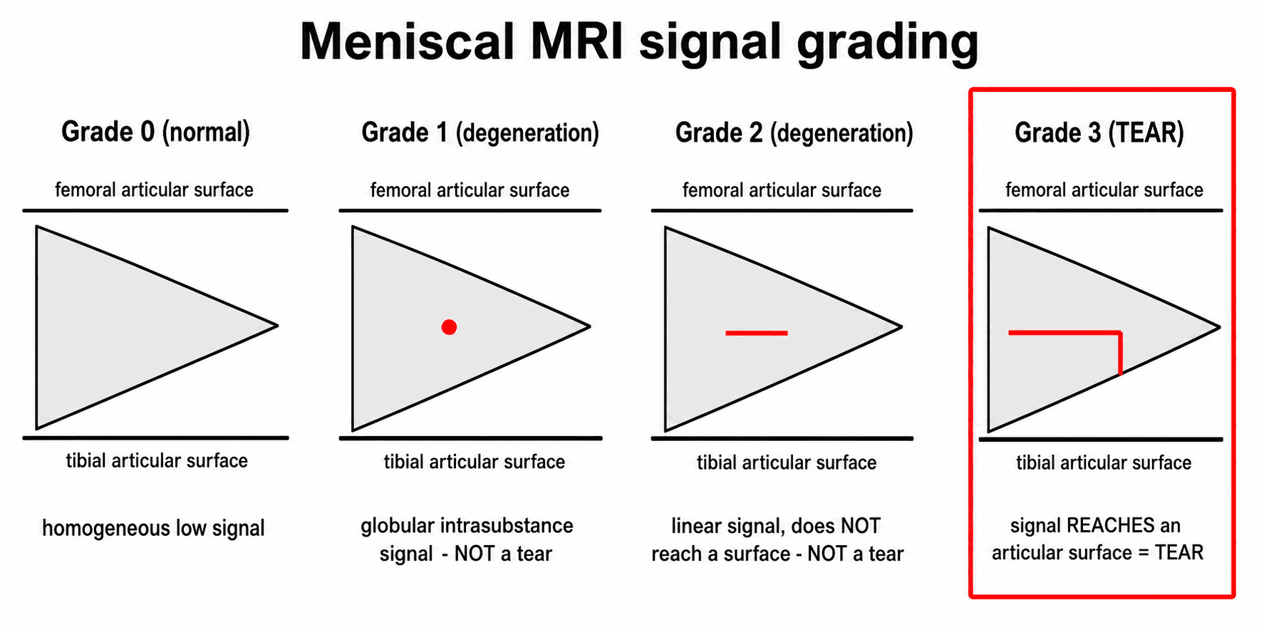 Schematic of meniscal MRI signal grades 0 to 3 showing intrasubstance signal versus signal reaching an articular surface