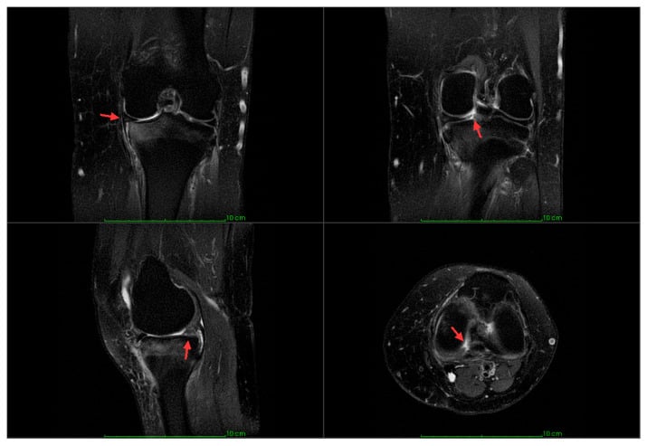 Multiplanar knee MRI showing medial meniscus posterior root tear signs including extrusion, cleft, ghost sign and radial defect.