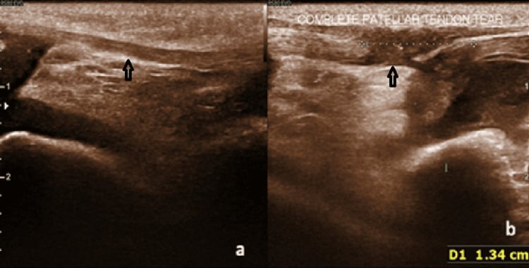 Ultrasound comparison of normal fibrillar patellar tendon and complete tendon tear.