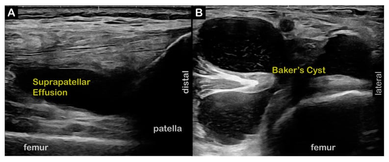 Long-axis suprapatellar and transverse posterior knee ultrasound showing effusion and Baker cyst.