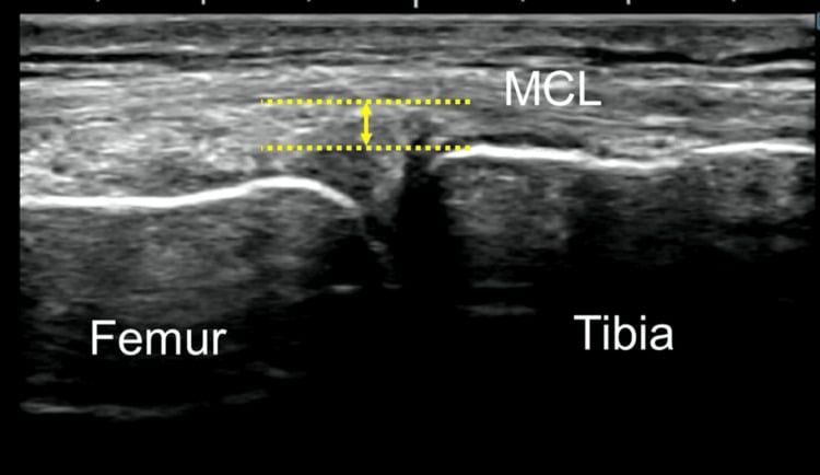 Medial knee ultrasound showing measurement of meniscal extrusion deep to the MCL.