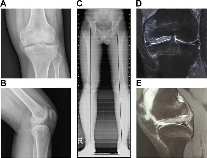 Radiographs, standing alignment film and MRI of a medial femoral condyle osteochondral defect.