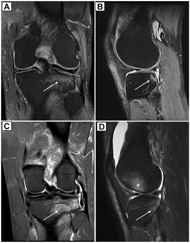 Coronal and sagittal fat-suppressed knee MRI showing lateral-compartment bone bruises after ACL tears.