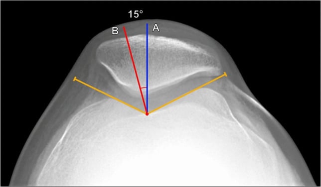 Merchant skyline radiograph with trochlear bisector and patellar congruence angle lines.