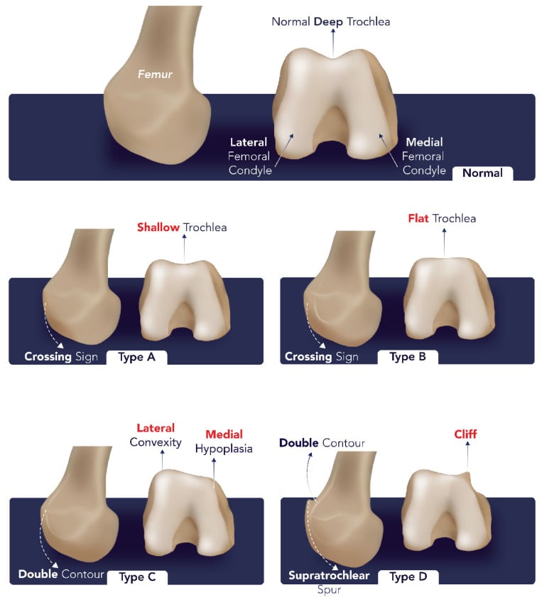 Illustrated Dejour trochlear dysplasia types A to D and their radiographic signs.