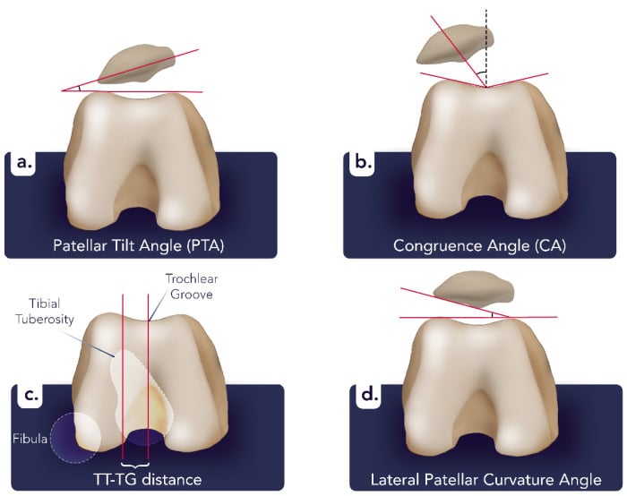 Illustrated Merchant-view patellar tilt, congruence angle, TT-TG distance and lateral patellar curvature measurements.