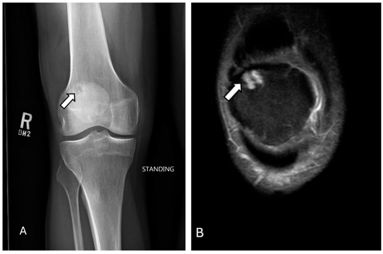Standing AP radiograph and axial MRI showing a well-corticated superolateral dorsal patellar defect without marrow oedema.