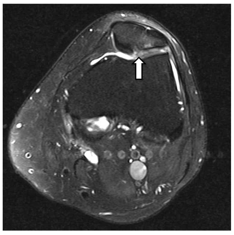Axial fat-suppressed MRI showing fissuring and thinning of patellar cartilage.