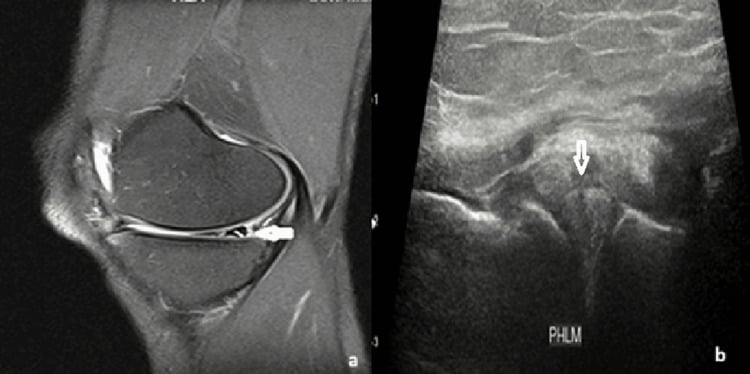 Paired sagittal MRI and ultrasound showing a vertical lateral meniscal tear.