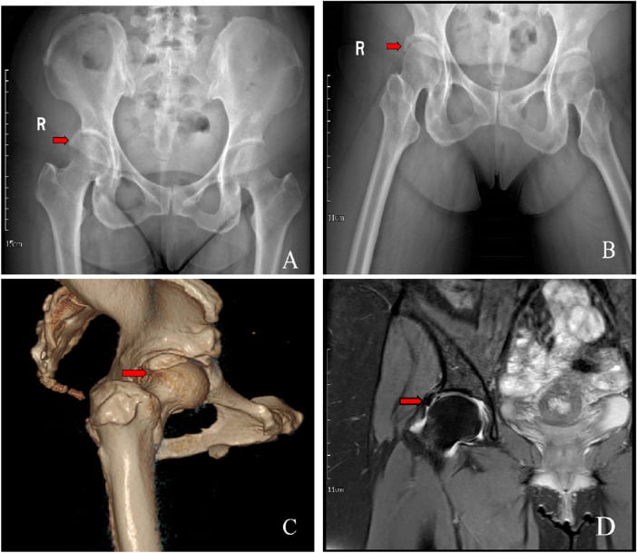 AP and Dunn radiographs, 3D CT and coronal MRI demonstrating complementary assessment of acetabular and labral pathology.