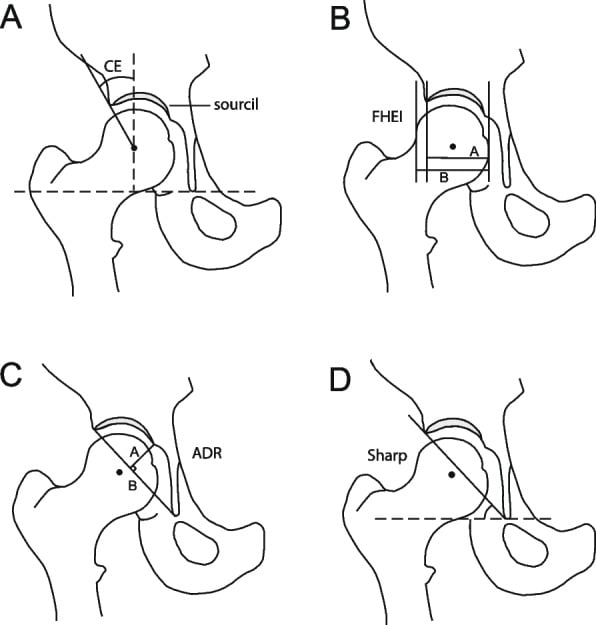 Line diagrams showing centre-edge angle, femoral-head extrusion index, acetabular depth ratio and Sharp angle.
