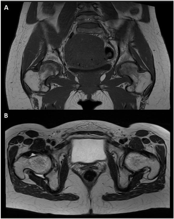 Coronal and axial hip MRI showing diffuse bilateral femoral-head marrow oedema without an osteonecrotic interface.