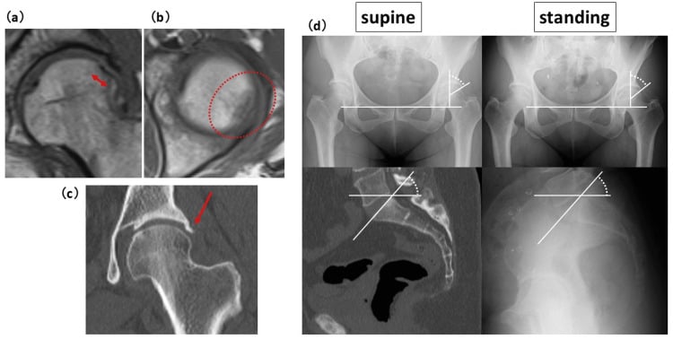 Coronal and axial MRI with CT showing a posterolateral subchondral femoral-head fracture.