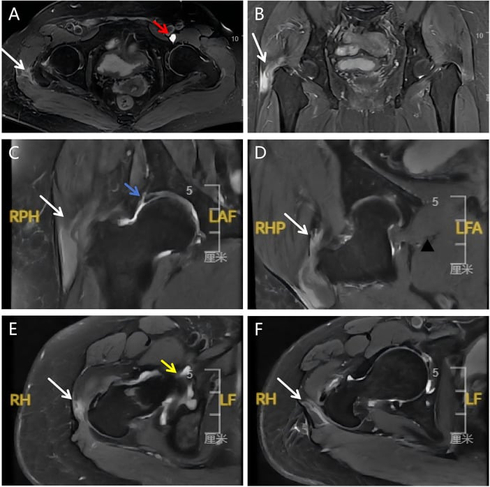 Multiplanar fat-suppressed hip MRI showing peritrochanteric oedema, abductor tendon injury and associated labral findings.