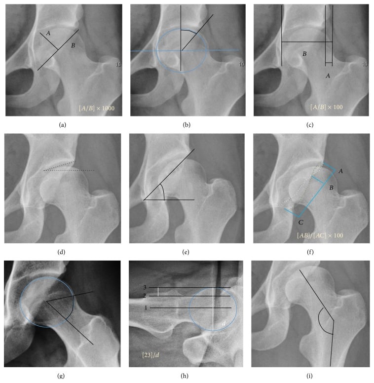 Nine hip radiographic measurements including centre-edge, TΓΆnnis, Sharp and alpha angles and femoral extrusion index.