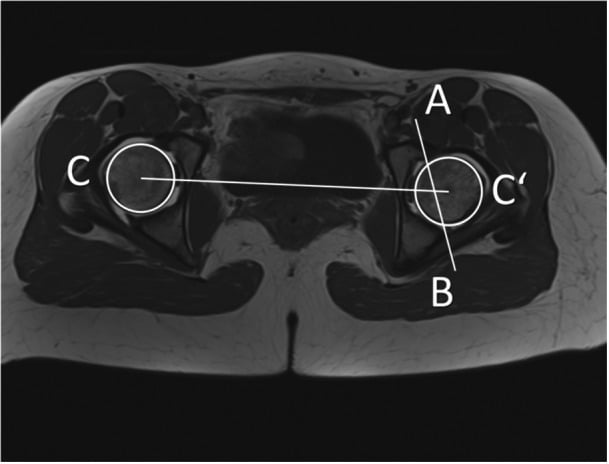 Axial CT showing acetabular version measured relative to the transverse axis through both femoral head centres.