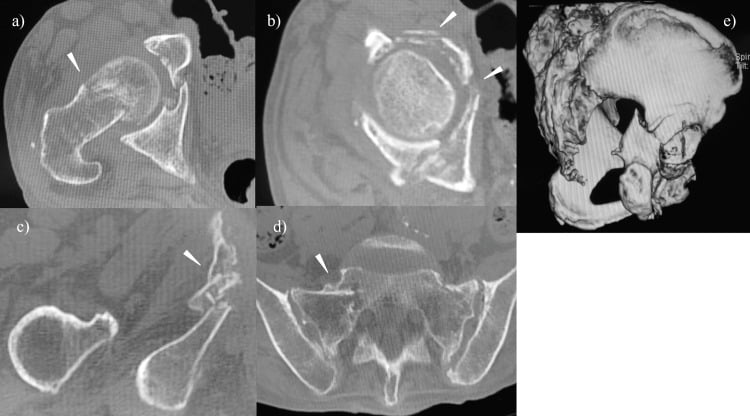 Multiplanar and 3D CT showing femoral neck, acetabular, pubic ramus, sacral ala and posterior column fractures.