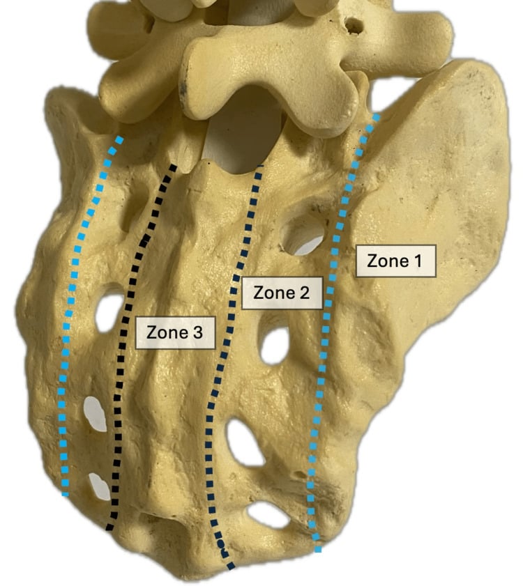 Posterior sacral model showing Denis zones 1 lateral to, 2 through and 3 medial to the neural foramina.