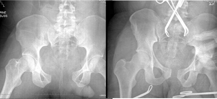 AP pelvic radiographs before and after binder application showing reduction of pelvic-ring displacement and volume.
