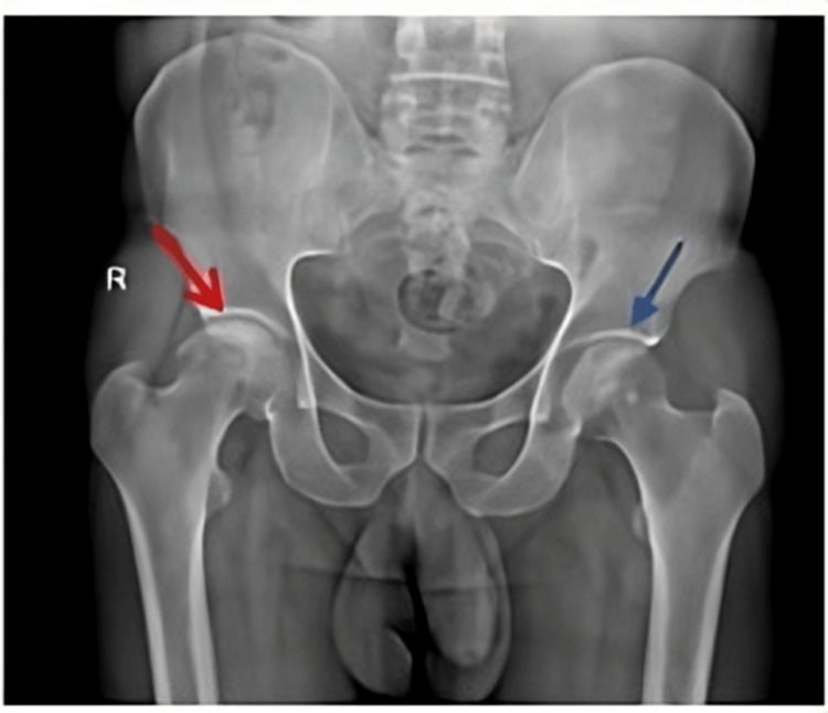 AP pelvis radiograph showing right femoral-head collapse and left subarticular sclerosis from bilateral osteonecrosis.