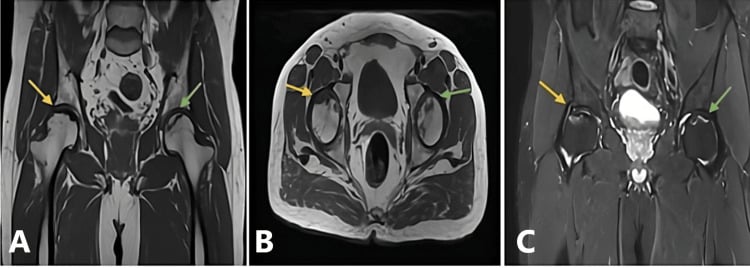 Coronal, axial and sagittal T1 MRI showing right femoral-head collapse and earlier left-sided osteonecrosis.