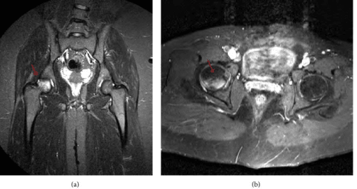 Coronal and axial hip MRI with arrows marking a subcortical wedge-shaped lesion and marrow oedema in the femoral head.