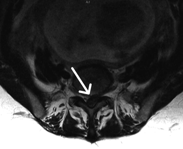 Axial T2 MRI at L5/S1 showing extruded disc almost completely filling the spinal canal