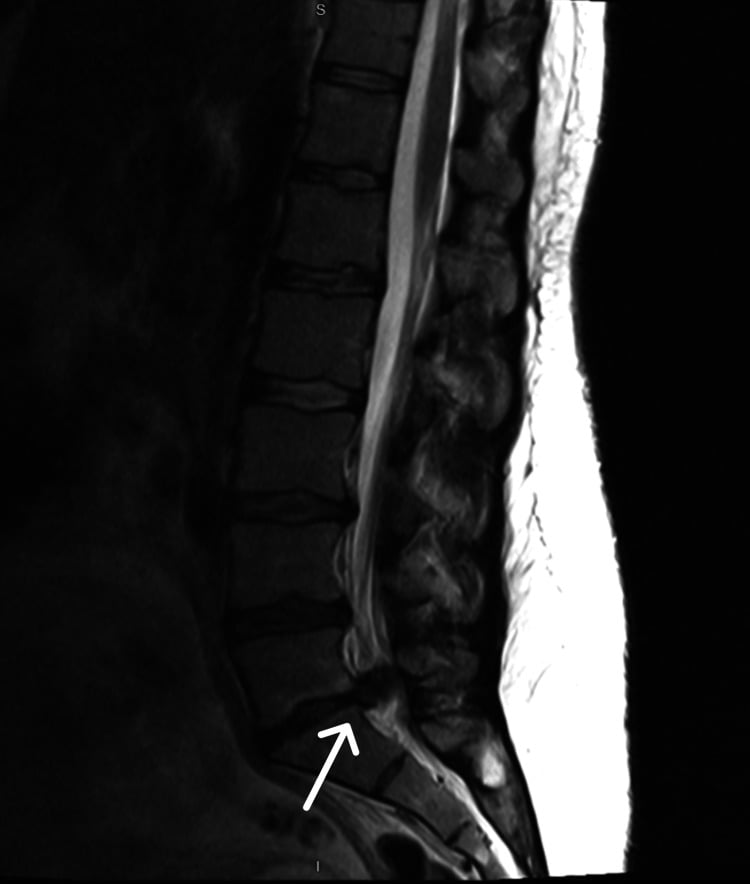 Sagittal T2 lumbar MRI showing a large L5/S1 disc extrusion filling the canal