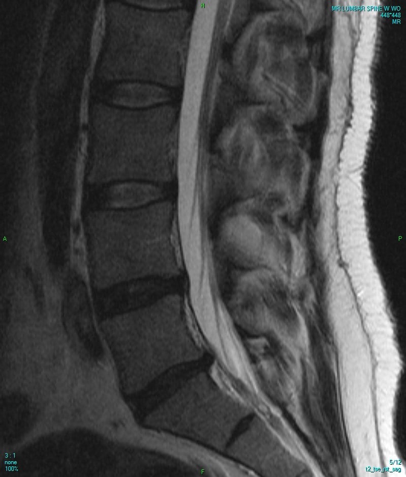 T2-weighted sagittal MRI of the lumbar spine showing vertebral bodies, discs, and the spinal canal.