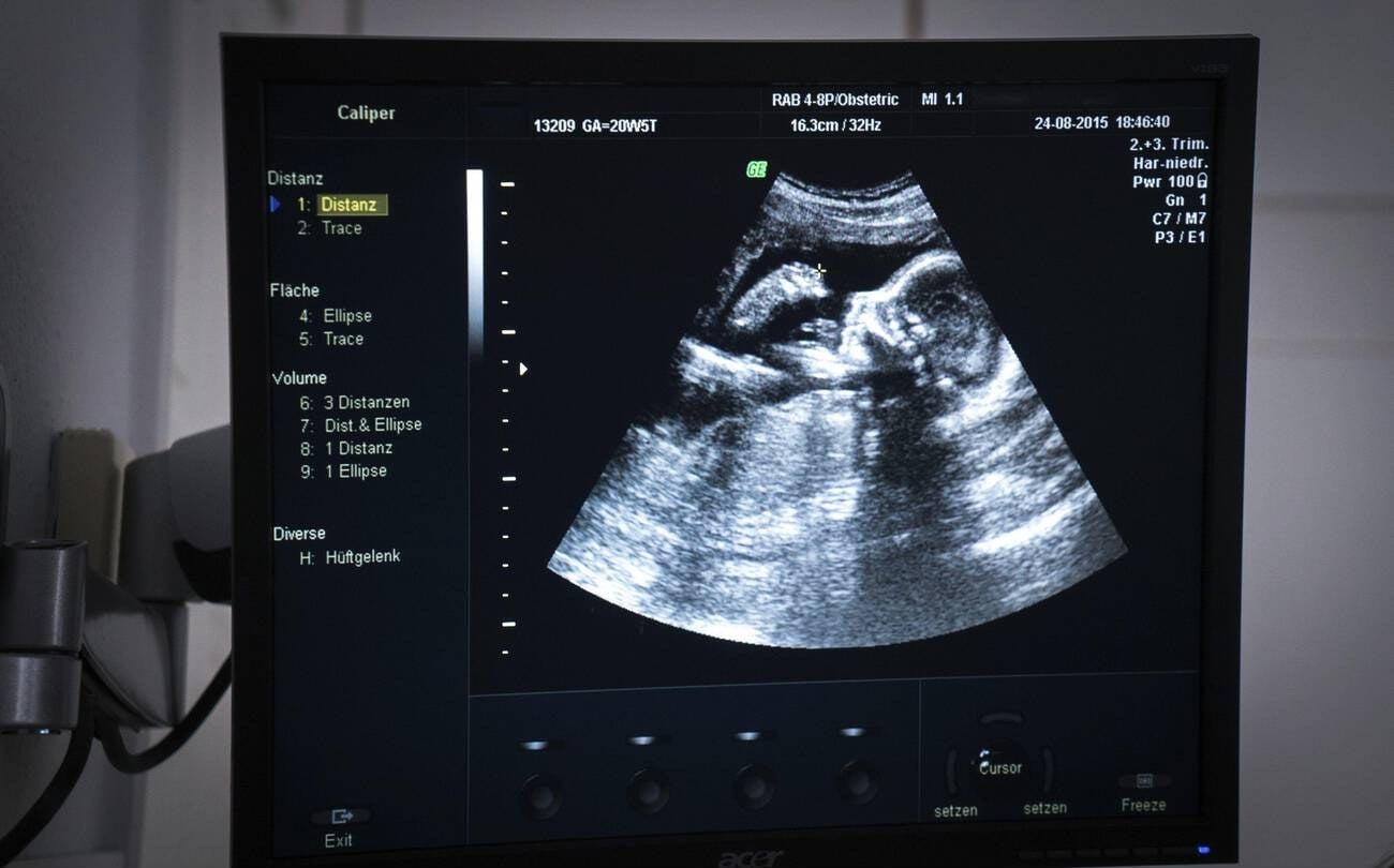 Obstetric ultrasound monitor showing a 2D scan of a mid-trimester fetus in profile.
